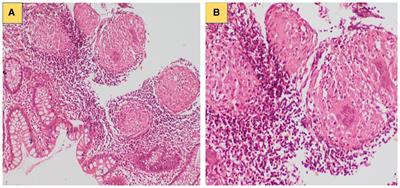 Case report: Chronic granulomatous disease presenting with early-onset inflammatory bowel disease and normal oxidative burst testing